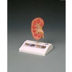  Kidney Stone Model